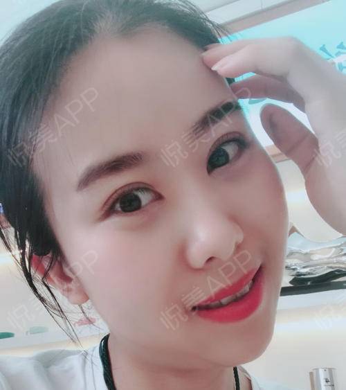 眼睛一點點恢復，越來越好看 眼部多項手術的蛻變之旅